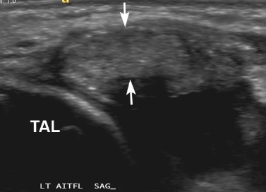 Figure 2 for case AITFL Desmitis